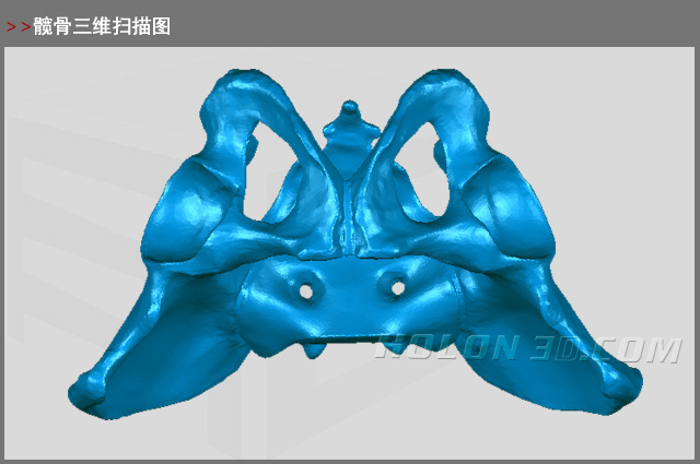 髖骨三維掃描圖